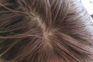 ヘアカラー 頭皮が弱く かぶれる場合の施術方法